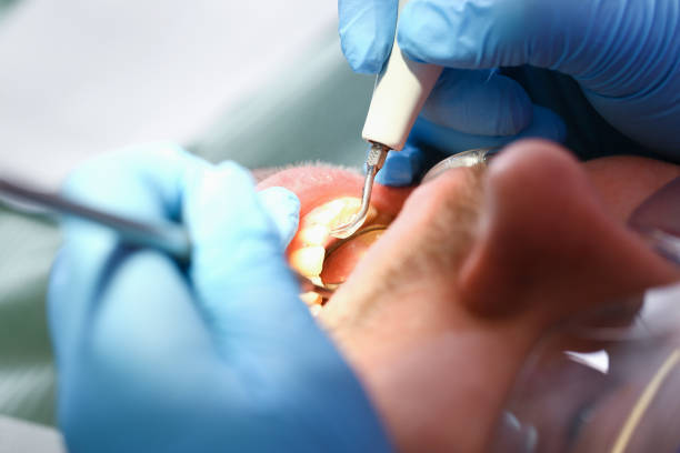 Best Urgent Care for Lost Fillings or Crowns in Centreville, VA