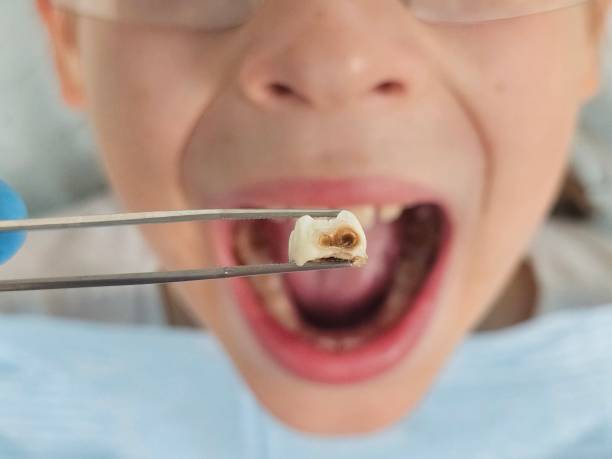 Best Emergency Treatment for Dental Infections or Abscesses in Centreville, VA